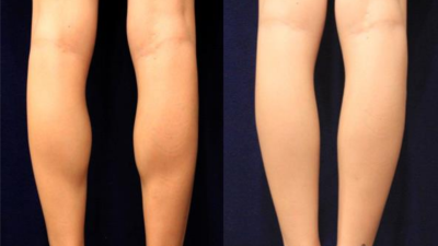 The Ultimate Guide to Calf Botox: Achieve Slimmer Legs